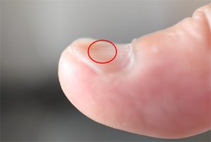 貧血,むく,み爪,変形,スプーン爪,二枚爪