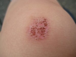 貧血,むく,み爪,変形,スプーン爪,二枚爪