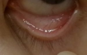 貧血,症状,チェックポイント,目,鉄欠乏性貧血