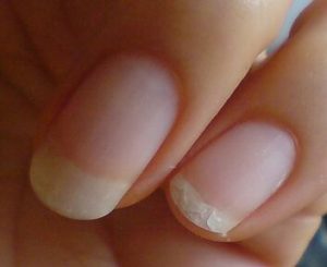 貧血,むく,み爪,変形,スプーン爪,二枚爪