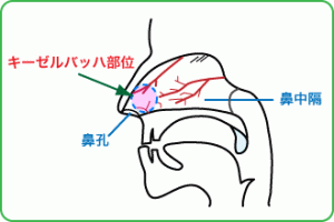 貧血、子供、貧血