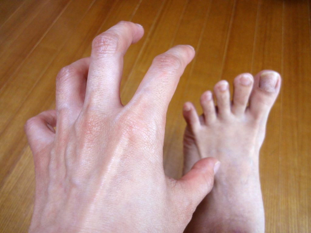 水虫 オロナイン