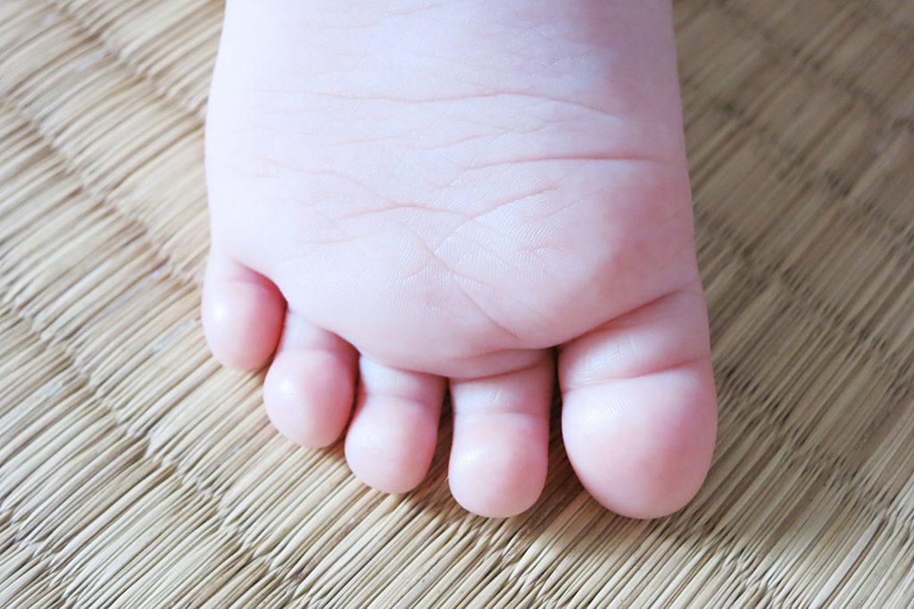 足の裏 水ぶくれ