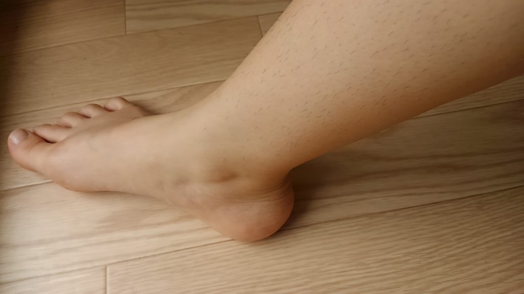 足首 腫れ