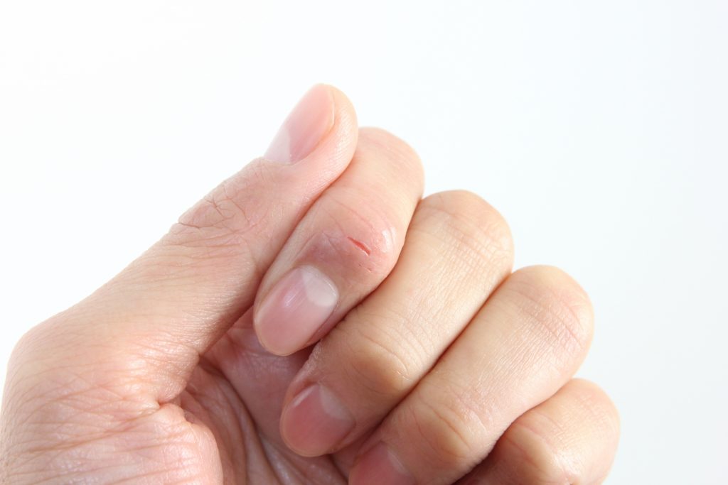 さかむけ　原因