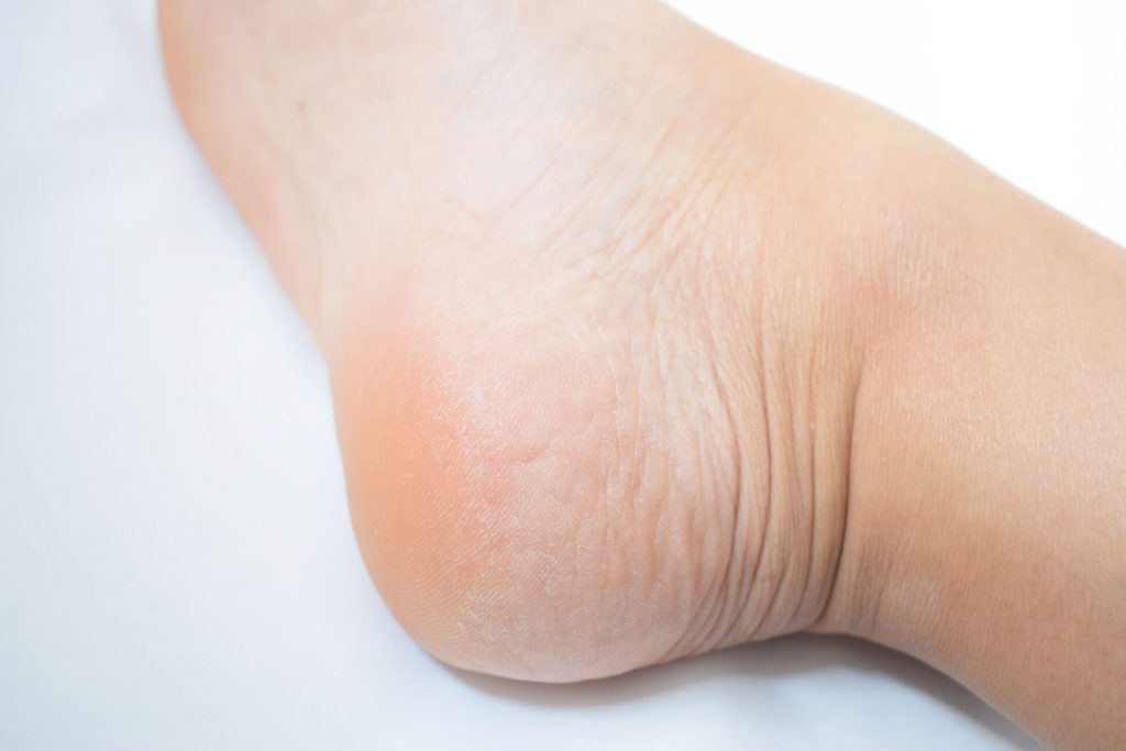 かかと ひび割れ